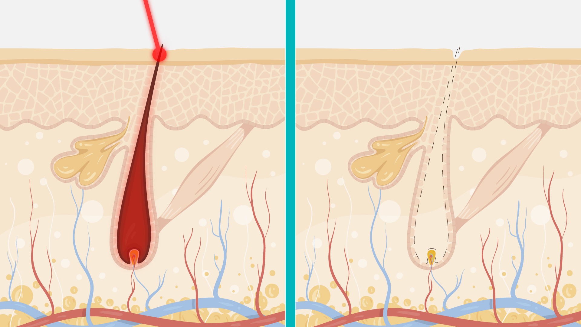 Como Funciona a Depilação a Laser e porque ela é tão eficaz