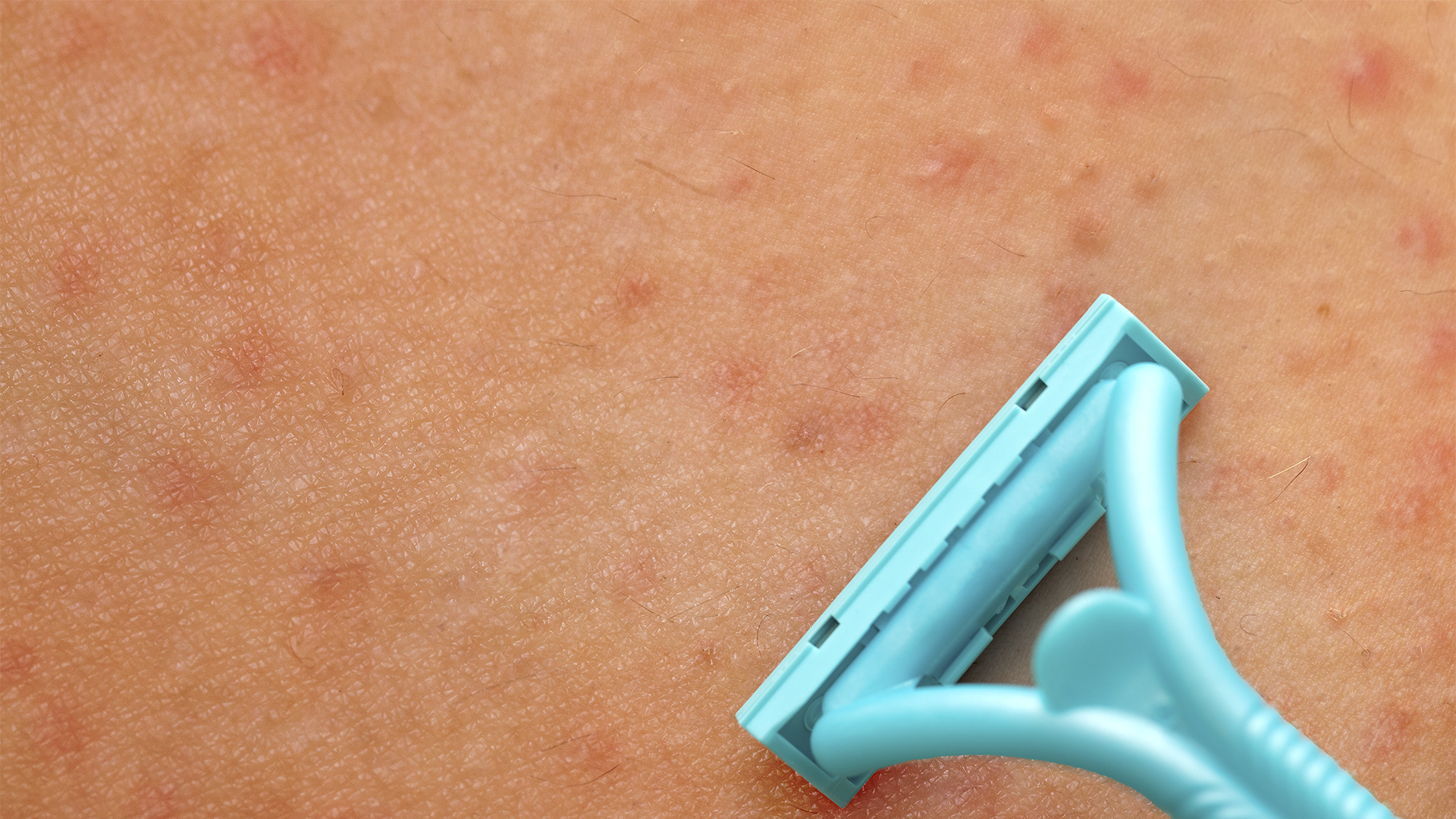 Como a Depilação a Laser Pode Beneficiar Quem Sofre de Foliculite?